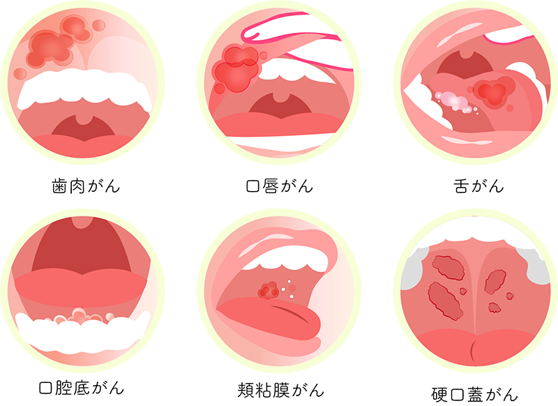 口腔がんの種類